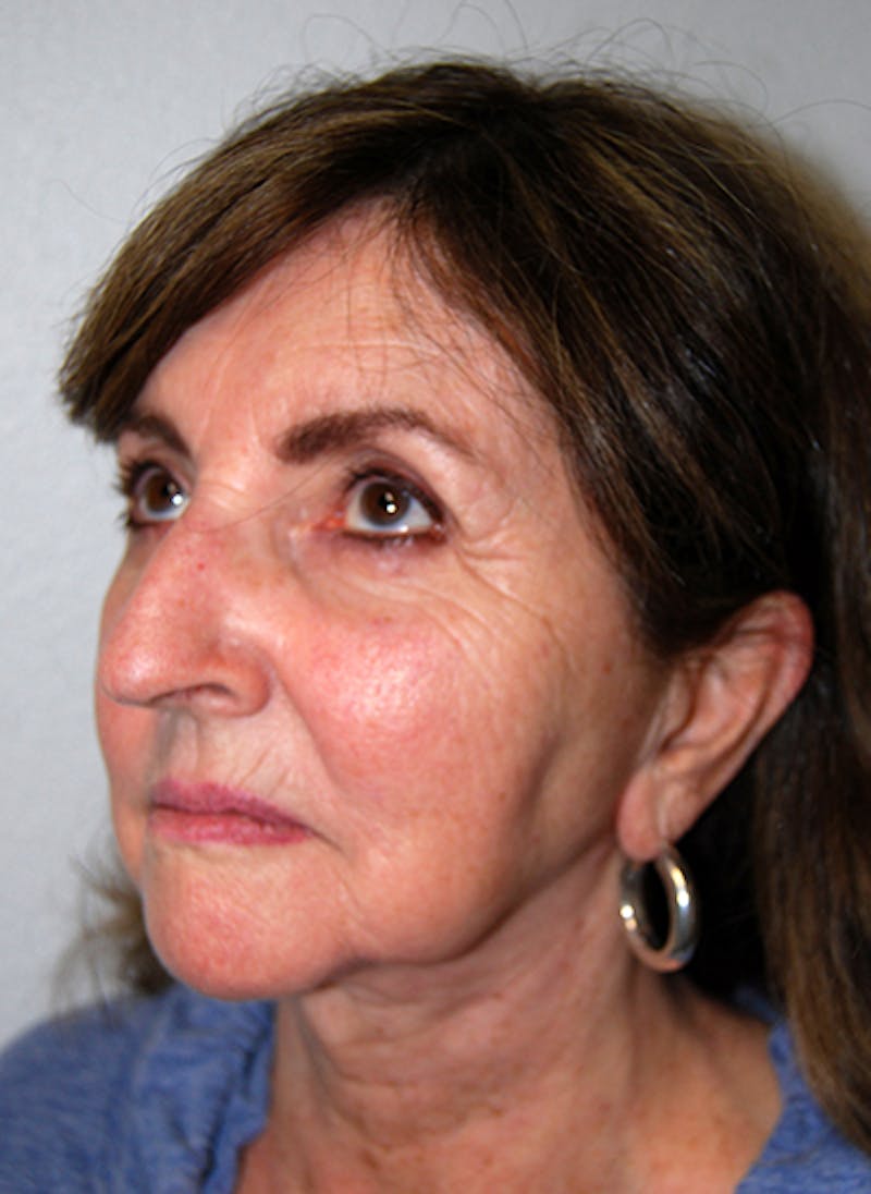 Facelift Before & After Gallery - Patient 109008 - Image 3
