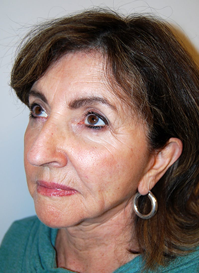 Facelift Before & After Gallery - Patient 109008 - Image 4