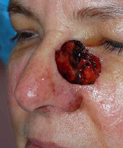 Mohs Cheek Before & After Gallery - Patient 157651 - Image 1