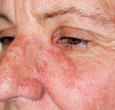 Mohs Cheek Before & After Gallery - Patient 157651 - Image 2