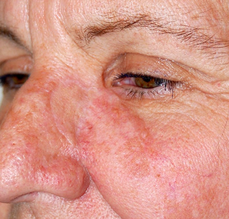Mohs Cheek Before & After Gallery - Patient 157651 - Image 2