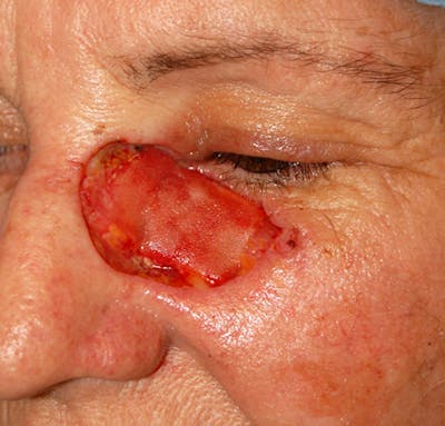 Mohs Cheek Before & After Gallery - Patient 151112 - Image 1