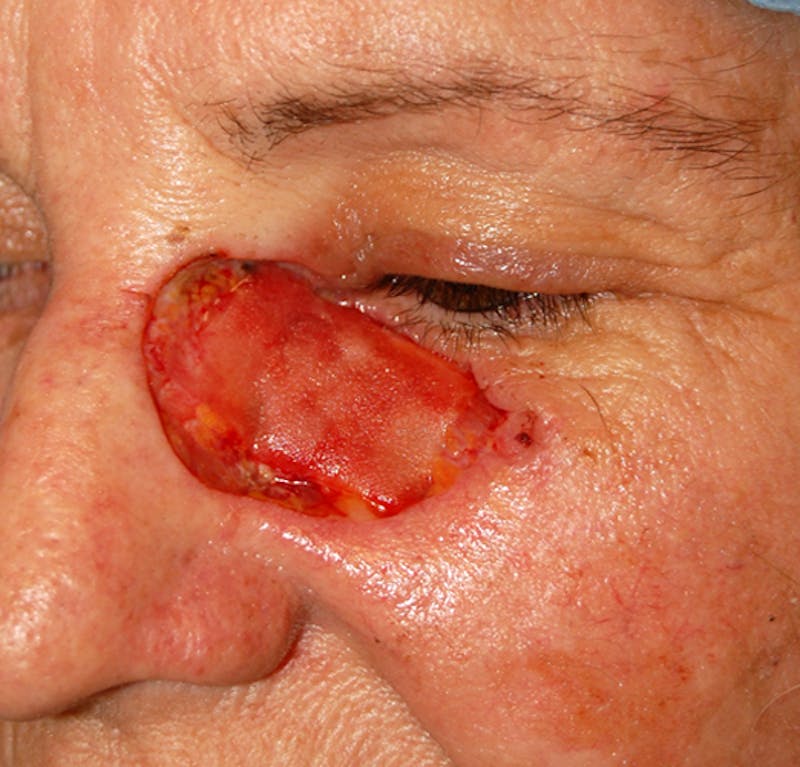 Mohs Cheek Before & After Gallery - Patient 151112 - Image 1