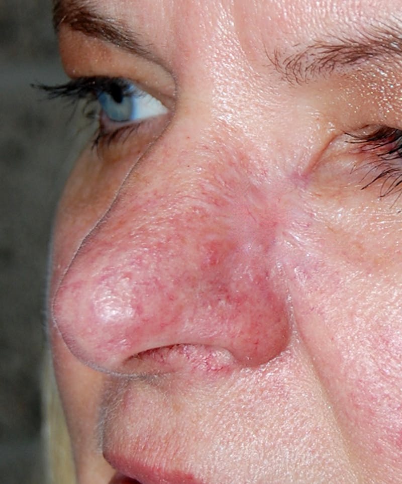 Mohs Cheek Before & After Gallery - Patient 151112 - Image 2