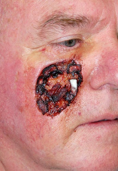Mohs Cheek Before & After Gallery - Patient 426365 - Image 1