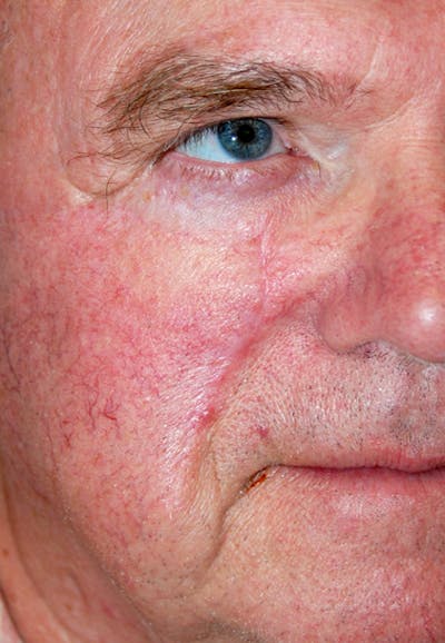 Mohs Cheek Before & After Gallery - Patient 426365 - Image 2