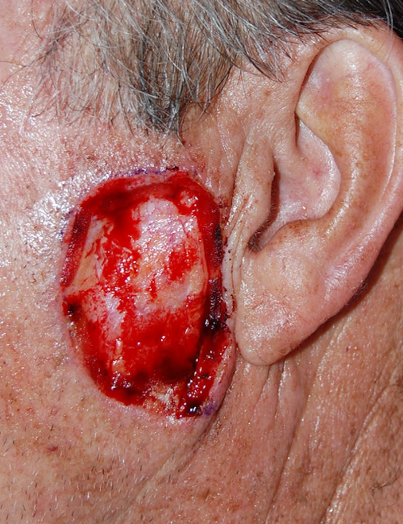 Mohs Cheek Before & After Gallery - Patient 404221 - Image 1