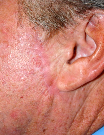 Mohs Cheek Before & After Gallery - Patient 404221 - Image 2