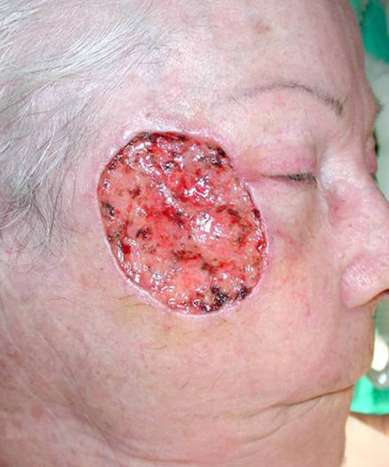 Mohs Cheek Before & After Gallery - Patient 210470 - Image 1