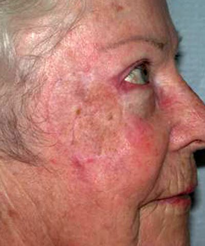 Mohs Cheek Before & After Gallery - Patient 210470 - Image 2