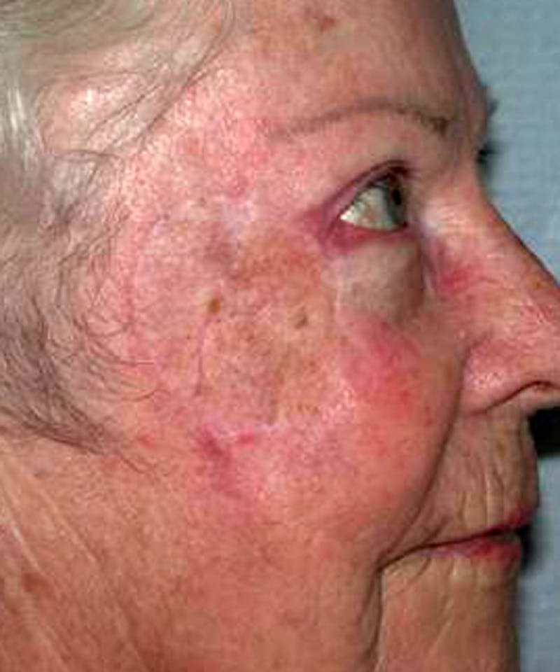Mohs Cheek Before & After Gallery - Patient 210470 - Image 2