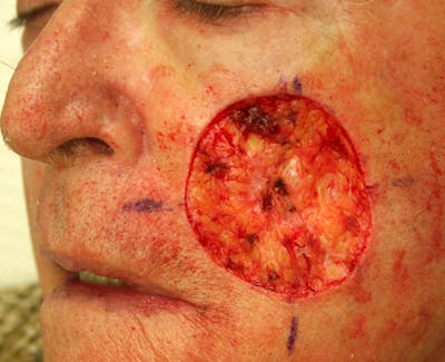 Mohs Cheek Before & After Gallery - Patient 233290 - Image 1