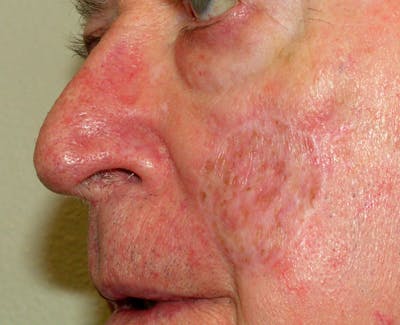 Mohs Cheek Before & After Gallery - Patient 233290 - Image 2