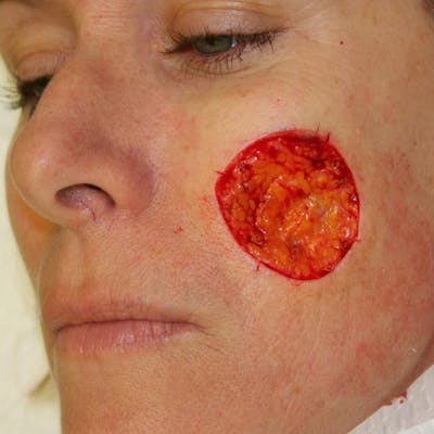 Mohs Cheek Before & After Gallery - Patient 103430 - Image 1