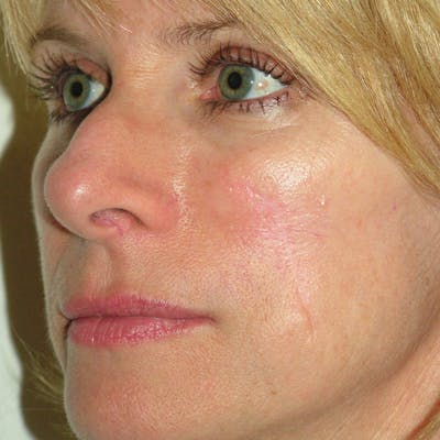 Mohs Cheek Before & After Gallery - Patient 103430 - Image 2