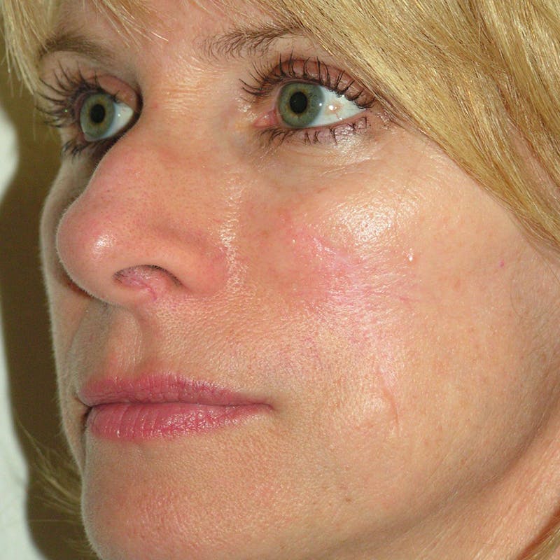 Mohs Cheek Before & After Gallery - Patient 103430 - Image 2