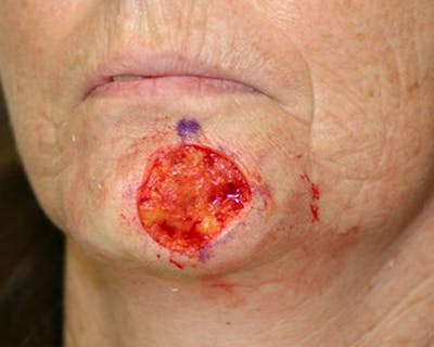 Mohs Chin Before & After Gallery - Patient 105526 - Image 1