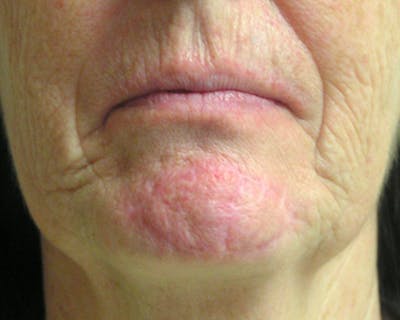 Mohs Chin Before & After Gallery - Patient 105526 - Image 2