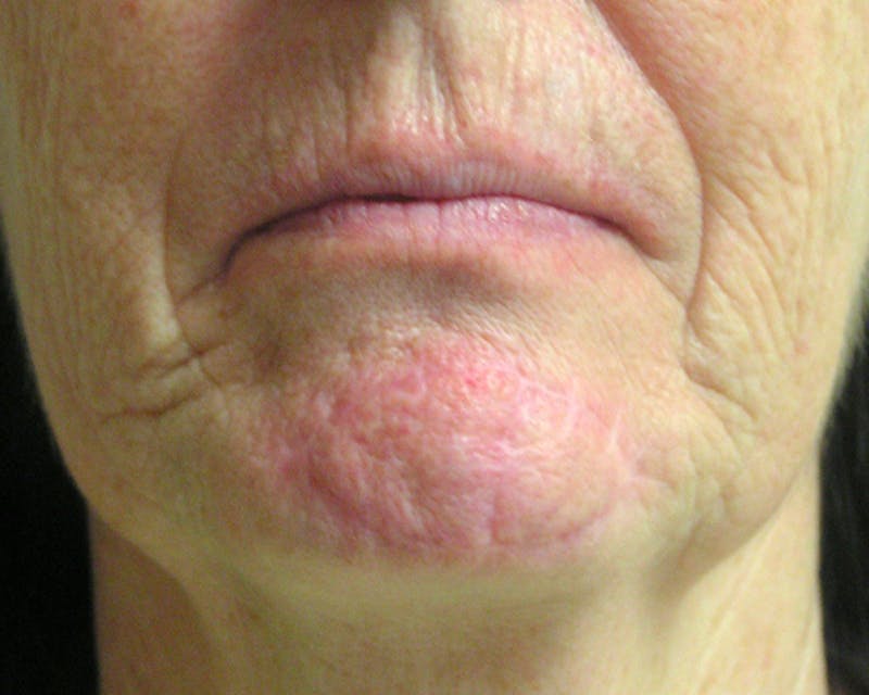 Mohs Chin Before & After Gallery - Patient 105526 - Image 2