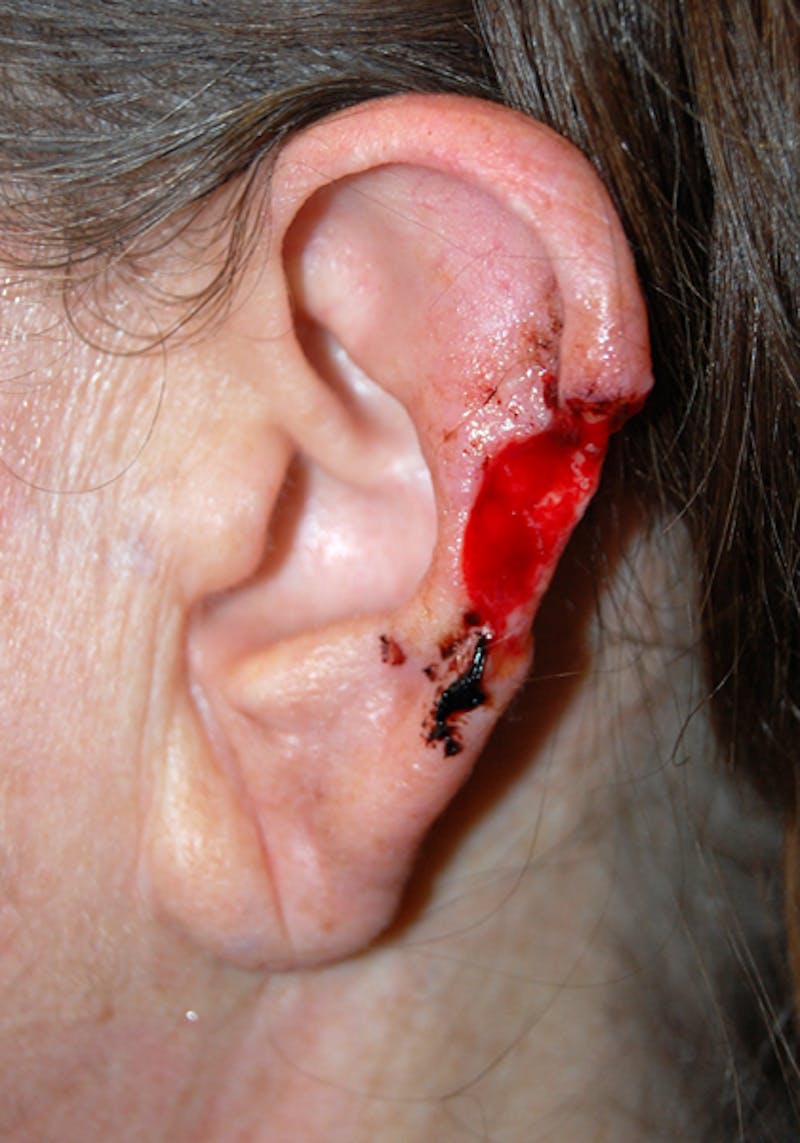 Mohs Ear Before & After Gallery - Patient 443352 - Image 1