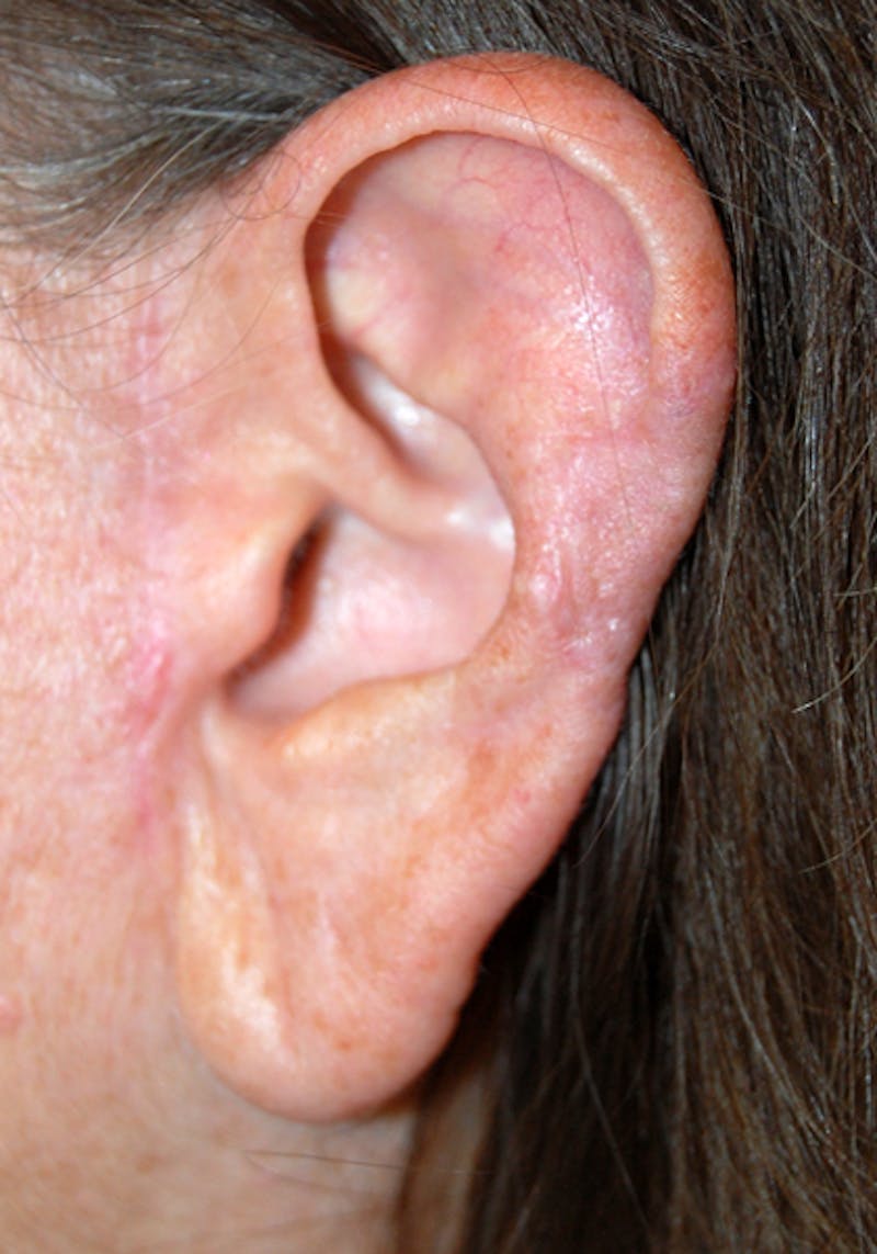 Mohs Ear Before & After Gallery - Patient 443352 - Image 2