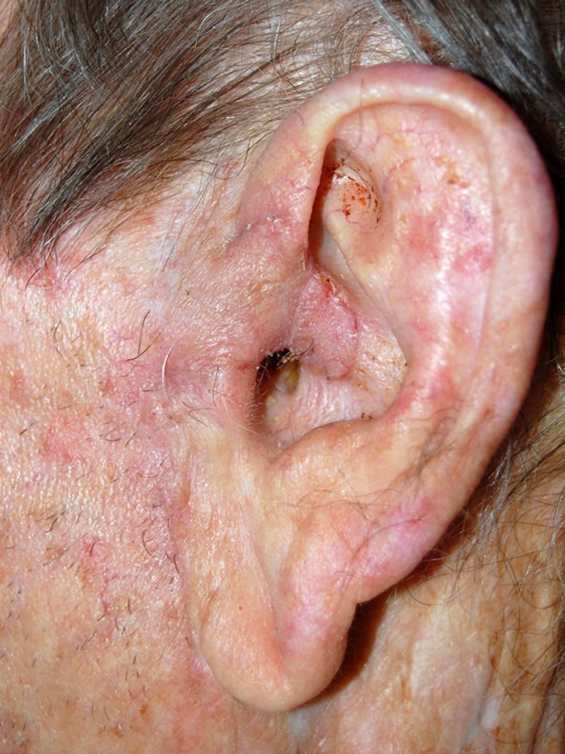 Mohs Ear Before & After Gallery - Patient 336438 - Image 1