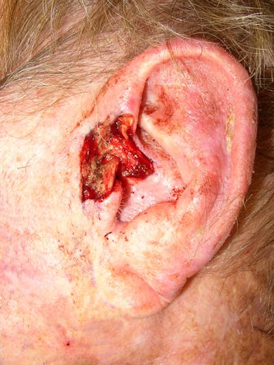 Mohs Ear Before & After Gallery - Patient 336438 - Image 2