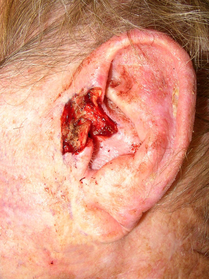 Mohs Ear Before & After Gallery - Patient 336438 - Image 2