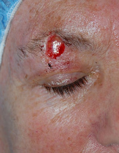 Mohs Eyebrow Before & After Gallery - Patient 280642 - Image 1