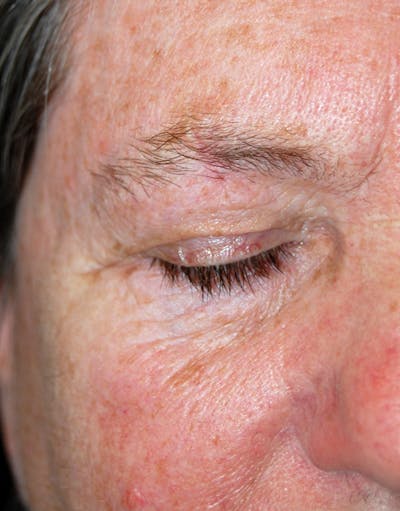 Mohs Eyebrow Before & After Gallery - Patient 280642 - Image 2
