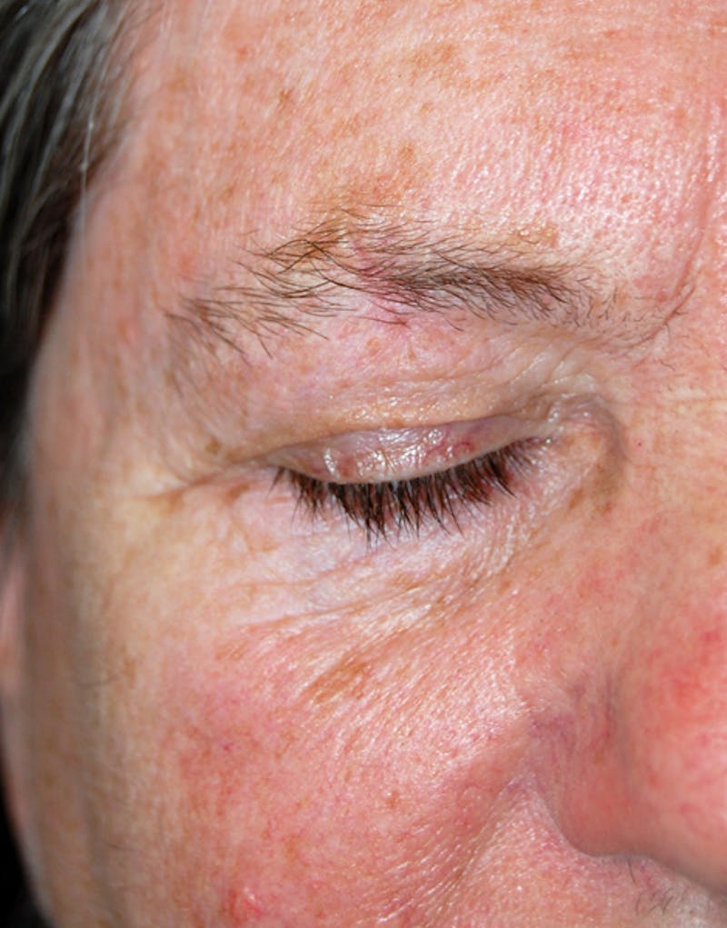 Mohs Eyebrow Before & After Gallery - Patient 280642 - Image 2