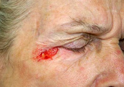 Mohs Eyelid Before & After Gallery - Patient 269799 - Image 1