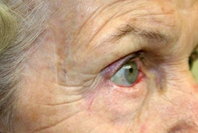 Mohs Eyelid Before & After Gallery - Patient 269799 - Image 2