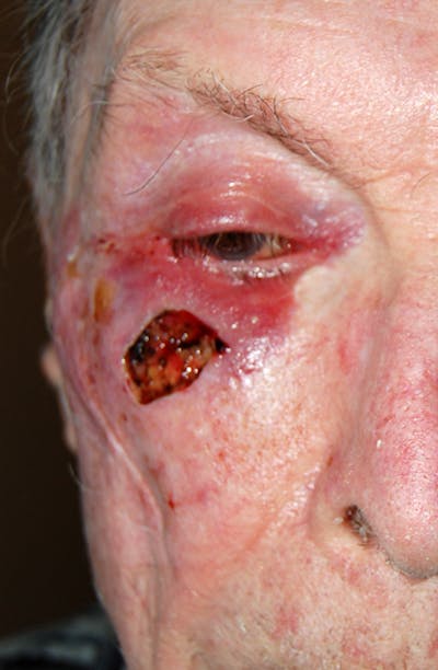 Mohs Eyelid Before & After Gallery - Patient 238238 - Image 1