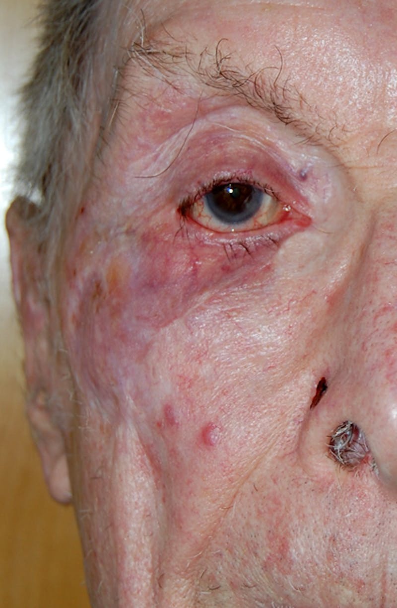 Mohs Eyelid Before & After Gallery - Patient 238238 - Image 2