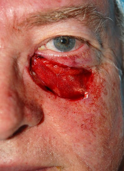Mohs Eyelid Before & After Gallery - Patient 376950 - Image 1