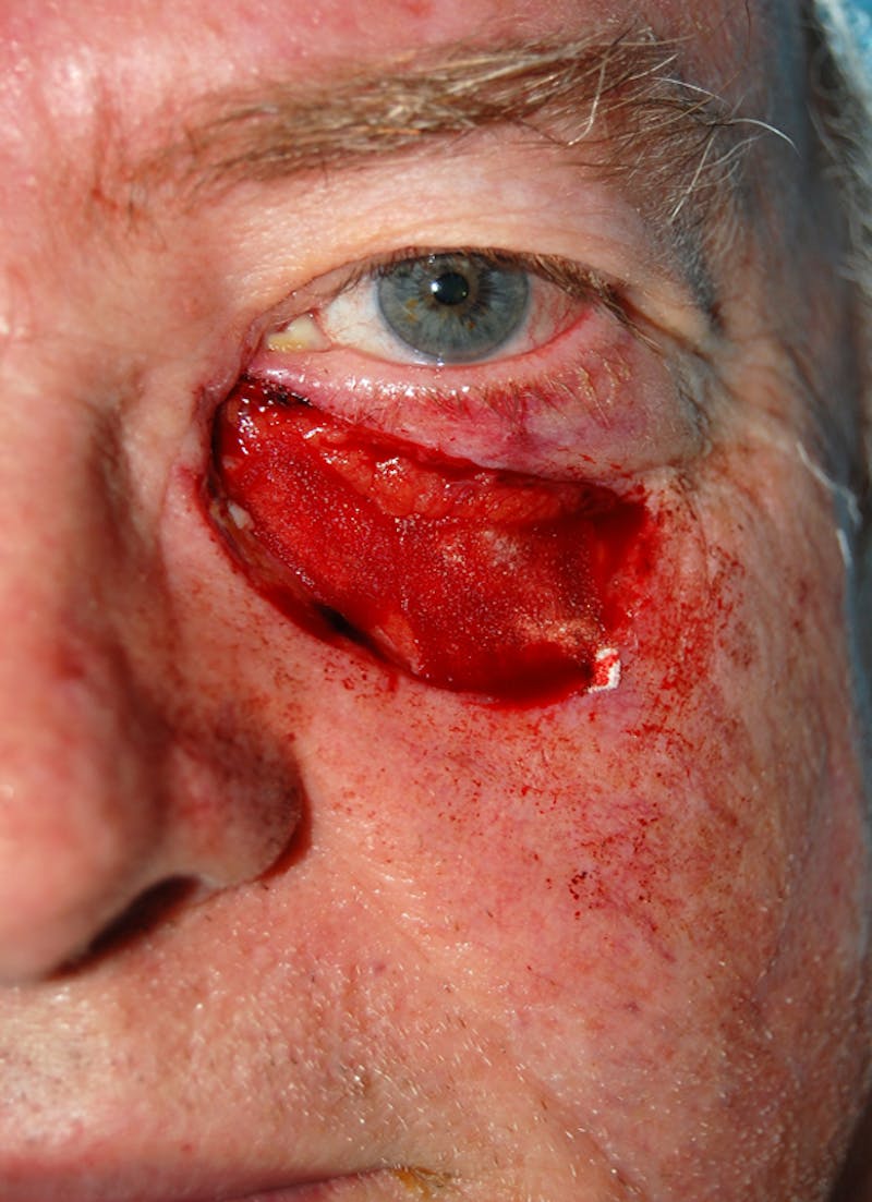 Mohs Eyelid Before & After Gallery - Patient 376950 - Image 1