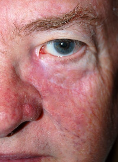 Mohs Eyelid Before & After Gallery - Patient 376950 - Image 2