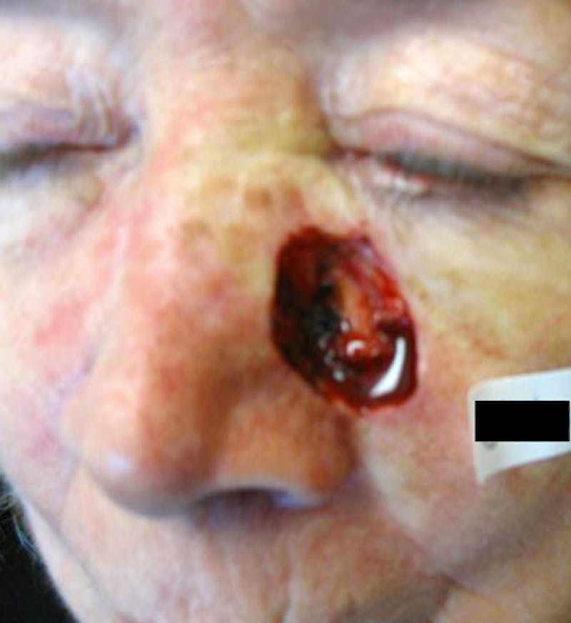 Mohs Eyelid Before & After Gallery - Patient 372558 - Image 1