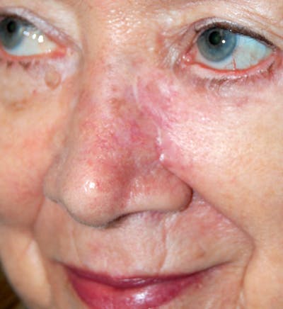 Mohs Eyelid Before & After Gallery - Patient 372558 - Image 2