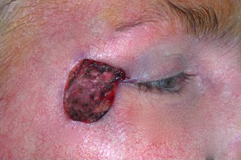 Mohs Eyelid Before & After Gallery - Patient 241316 - Image 1