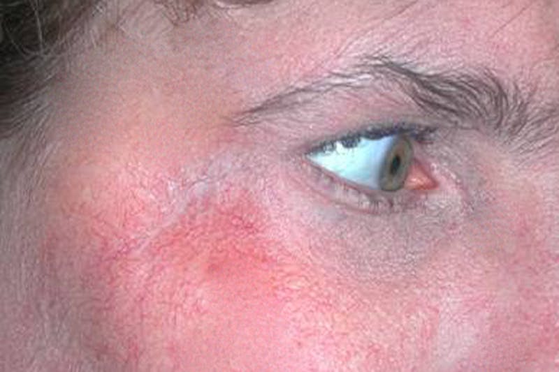 Mohs Eyelid Before & After Gallery - Patient 241316 - Image 2