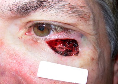 Mohs Eyelid Before & After Gallery - Patient 922489 - Image 1