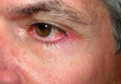 Mohs Eyelid Before & After Gallery - Patient 922489 - Image 2