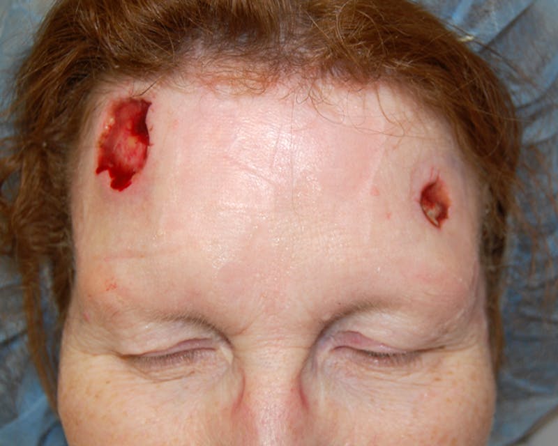 Mohs Forehead Before & After Gallery - Patient 996863 - Image 1