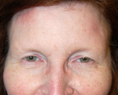 Mohs Forehead Before & After Gallery - Patient 996863 - Image 2