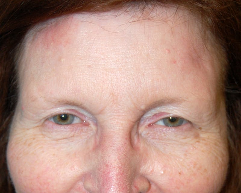 Mohs Forehead Before & After Gallery - Patient 996863 - Image 2