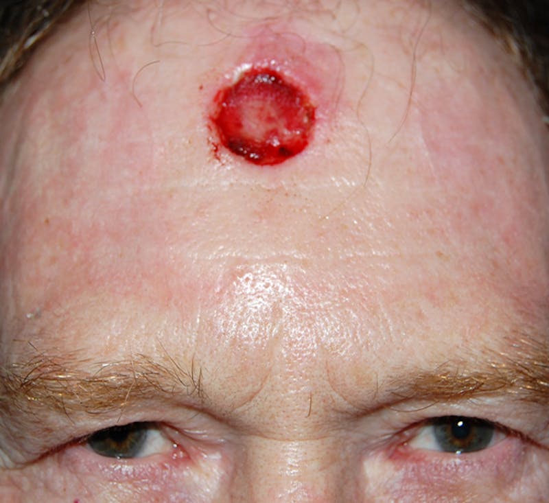 Mohs Forehead Before & After Gallery - Patient 107453 - Image 1
