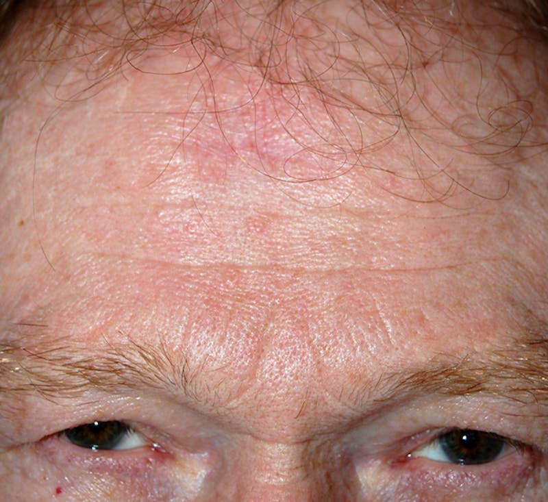 Mohs Forehead Before & After Gallery - Patient 107453 - Image 2