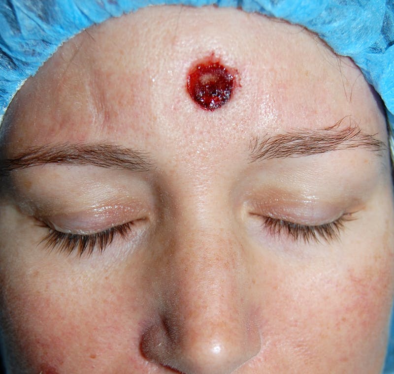Mohs Forehead Before & After Gallery - Patient 385991 - Image 1